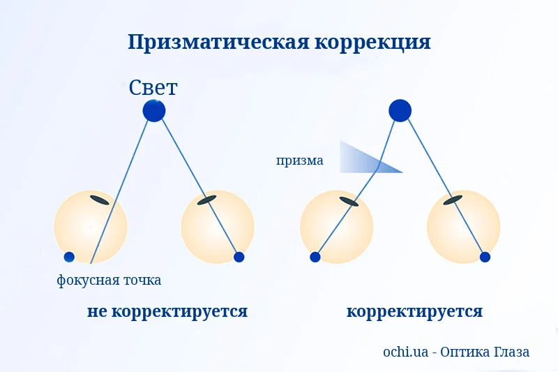 Нарушение бинокулярного зрения и призматическая коррекция